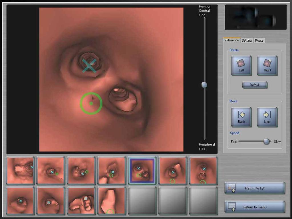ERS MONOGRAPH INTERVENTIONAL PULMONOLOGY Figure 5. Virtual bronchoscopy with the Bf-NAVI system (Cybernet Systems, Tokyo, Japan).