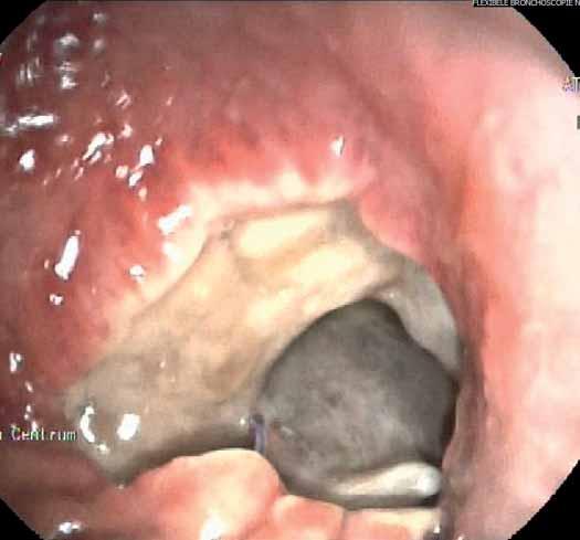 FLEXIBLE BRONCHOSCOPY J.M.A. DANIELS a) Figure 3. Dehiscence of the bronchial anastomosis after sleeve lobectomy of the right upper lobe. Note the sudden stop of bright pink bronchial wall.