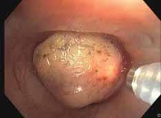 e) Final status after endoscopic debulking with thermocoagulation showing patent distal airways.