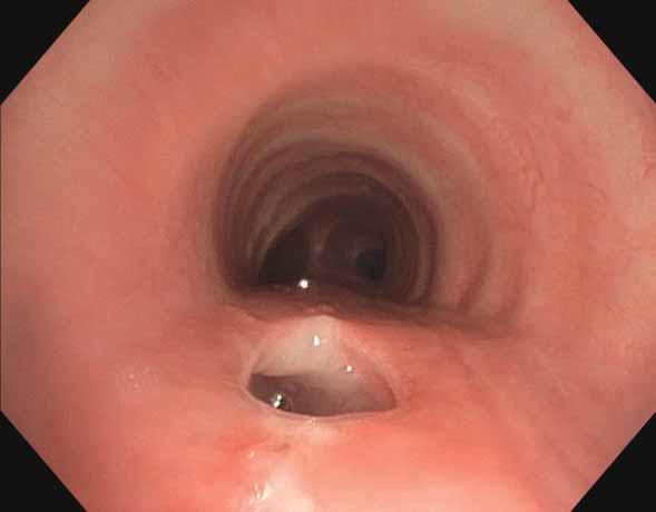 AIRWAY FISTULAS C. DOOMS AND J. YSERBYT a) b) c) Figure 2. a) Bronchosocpy performed 2.