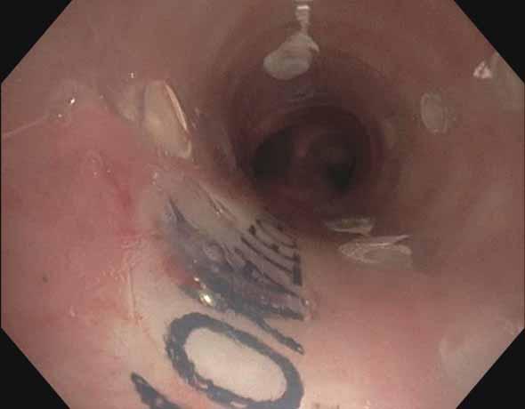 carina; b) a temporary tracheal silicone stent of 50 18 mm inserted successfully to cover the fistula; c) after a 6-month interval, the stent has been removed, and a one-stage tracheal transection