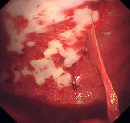 LOCAL ANAESTHETIC THORACOSCOPY R. BHATNAGAR ET AL. a) b) c) Figure 4. Use of pleural cryobiopsy to diagnose mesothelioma.
