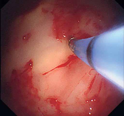 Improving videoscopic appearance The typical thoracoscopy, much like bronchoscopy or endoscopy, involves the use of white light, giving the operator a visual representation of the pleural landscape