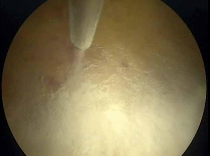 LOCAL ANAESTHETIC THORACOSCOPY R. BHATNAGAR ET AL. a) Figure 9. Image of thoracoscopic talc pleurodesis. Reproduced with kind permission of N. Rahman (University of Oxford, Oxford, UK).