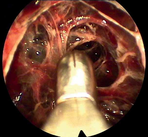 ERS MONOGRAPH INTERVENTIONAL PULMONOLOGY a) Figure 11. Example of a highly loculated infected pleural space.