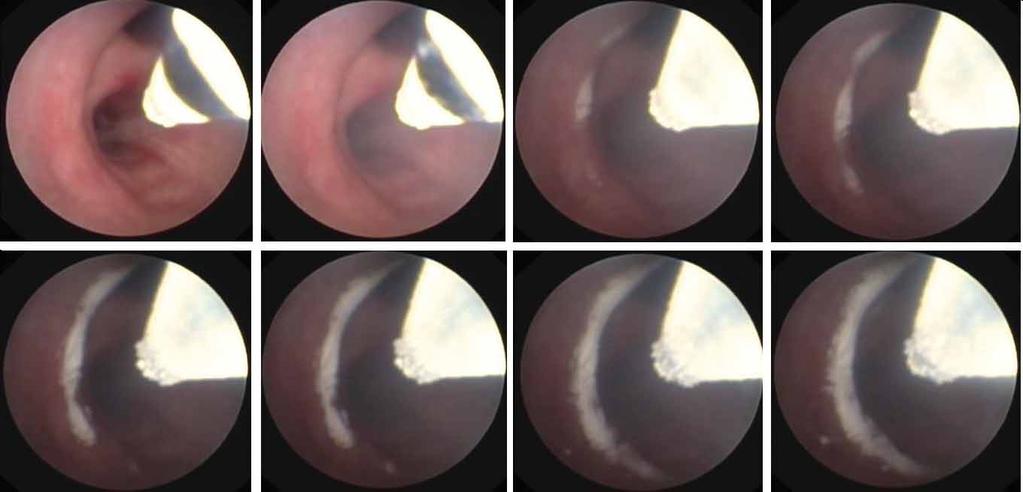 UPCOMING TECHNIQUES D. GOMPELMANN Figure 3. Bronchoscopic images. Cryospray therapy in the right main bronchus. Reproduced with kind permission of D-J.