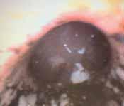 obstruction (any or combination) IV Massive injury Evidence of mucosal sloughing,
