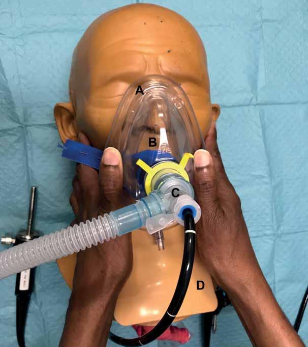 BRONCHOSCOPY IN THE ICU S. SINGH Figure 2. Bronchoscopy through a noninvasive ventilation mask. A) Mask (oronasal; full face mask alternative). B) Mouth guard (blue).