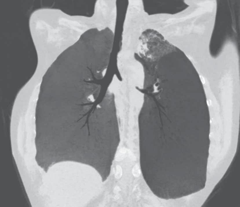 ERS MONOGRAPH INTERVENTIONAL PULMONOLOGY datasets provides several additional advantages: 1) the ability to pass stenoses virtually, 2) the view of the stenosis is not limited to a