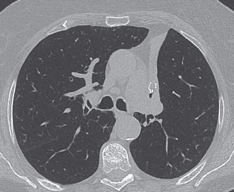 IMAGING S. LEY AND C.P. HEUSSEL Figure 8. The same patient as in figures 6 and 7. After correction of the endobronchial valve, a follow-up CT was performed.