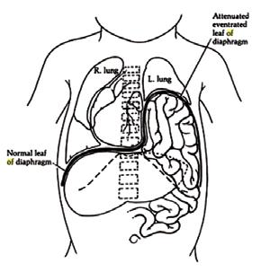 vomiting. The abnormally wide subdiaphragmatic space provides the potential for abnormal rotation of stomach around itself. This abnormal rotation is known as gastric volvulus.