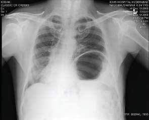 Organoaxial GV usually occurs acutely and is associated with a diaphragmatic defect, whereas mesenteroaxial GV is partial (torsion < 180 ), recurrent and not associated with a diaphragmatic defect.