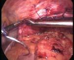 Eventration of diaphragm with volvulus in the diagnosis, in view of associated gastric volvulus,
