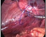 Under general anesthesia, with patient in supine position, 10 mm primary port was inserted by open