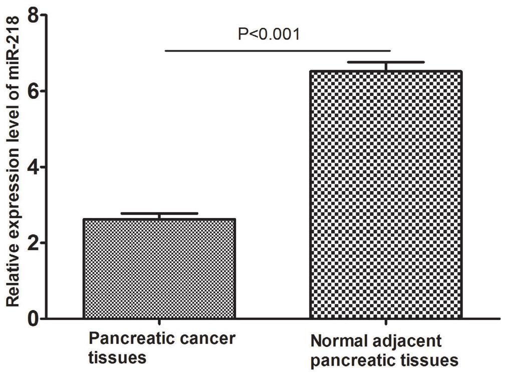 mir-218 is a prognosis factor for pancreatic cancer 16375 pancreatic cancer tissues was strongly correlated with the TNM classification (P = 0.02), distant metastasis (P = 0.
