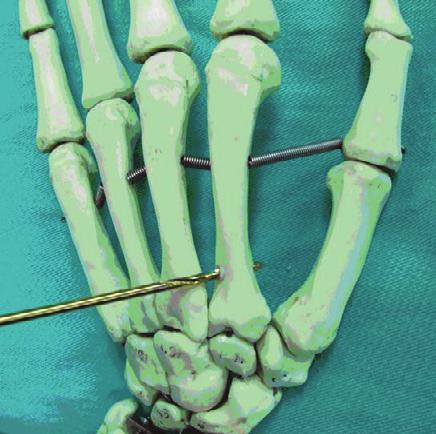 ARTHROPLASTY OF THE TRAPEZIOMETACARPAL JOINT abductor pollicis longus (APL) tendon ending on the other side at the level of the metaphysis (Figure 1).