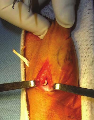 (Figure 6). After the tendon graft was passed through the tunnels, the subluxated thumb basal joint was reduced and distracted.