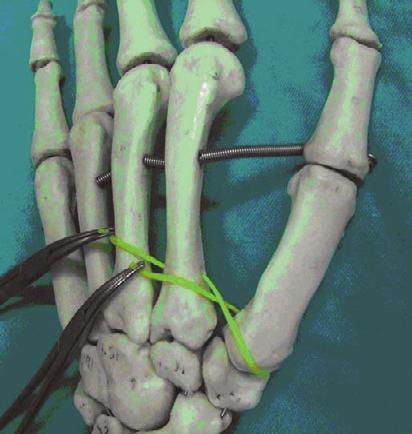 Finally, the two ends of the graft were sutured side-to-side on the Figure 4. Palmaris tendon is passed through first metacarpal bone tunnel. Figure 2.