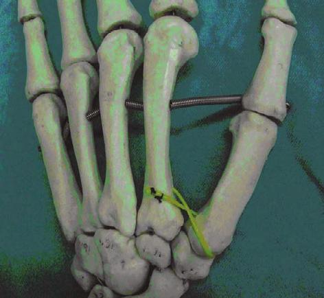 Radiograph taken 12 months after the operation, thumb basal joint is in good reduction position. Figure 8.
