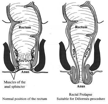Delormes Operation for Rectal Prolapse Your Questions Answered What is a rectal prolapse?