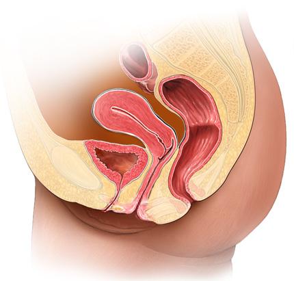 What is a posterior prolapse? A posterior prolapse is a bulge in the back wall of your vagina. It is caused by weakness of the support tissues between your vagina and your bowel (see figure 1).