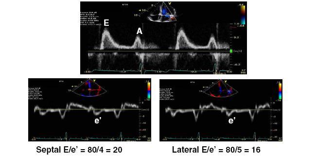 TISSUE DOPPLER VELOCITY IMAGING (+) E/E` The ratio of mitral velocity to early diastolic velocity of the mitral annulus (E/E`) showed a better correlation with M-LVDP than did other Doppler variables