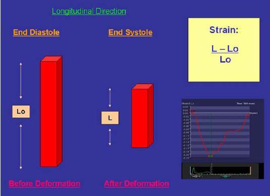 LA Myocardial deformation An alternative method of exploring LA function; Strain and strain rate (SR) imaging have emerged as a