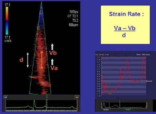 Regional strain and strain rate measurements by cardiac ultrasounds: principles, implementation and limitations.