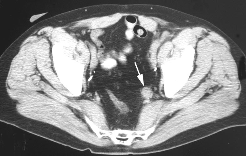 Patterns of bladder cancer recurrence 97 risk of relapse, there is a paucity of data describing the imaging features of recurrent bladder cancer following surgery.