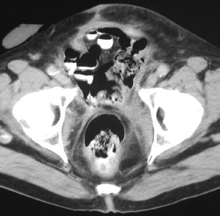 Post-contrast axial CT through the lower pelvis showing ill-defined