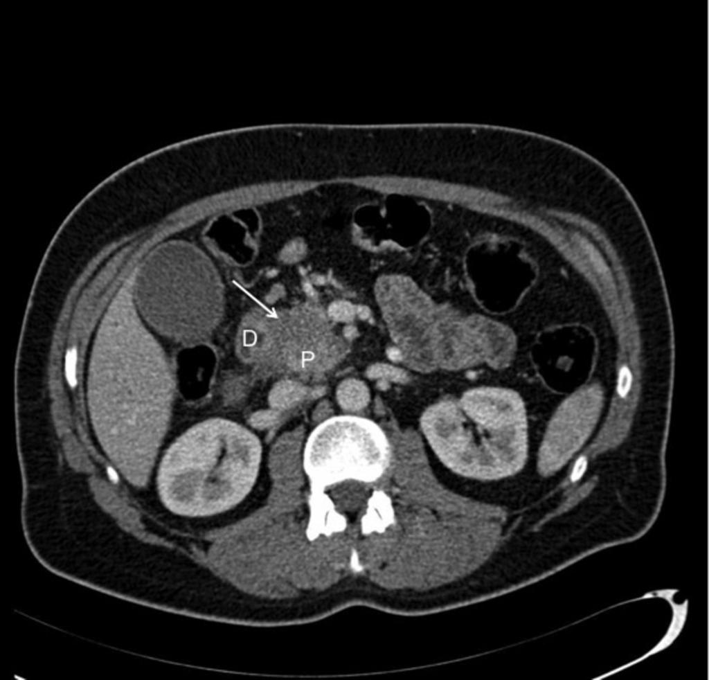 Fig. 7: Axial CT showing soft tissue attenuation mass extending into the PD groove from the head of the pancreas.