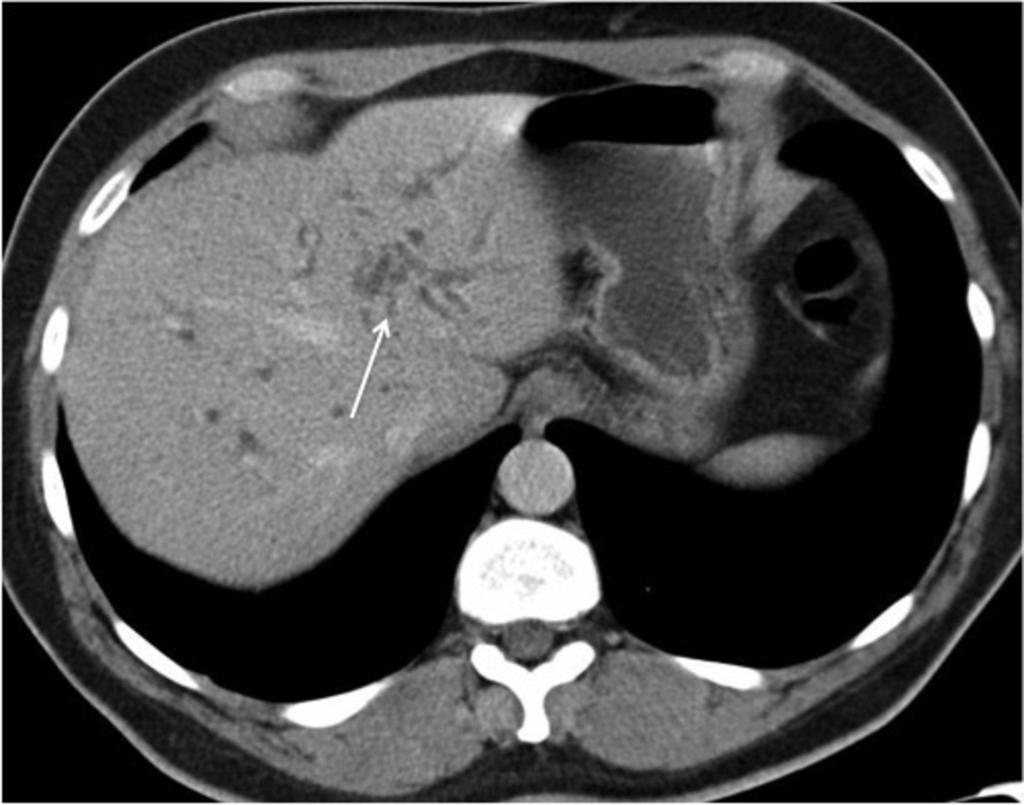 Fig. 8: Axial CT showing biliary obstruction with