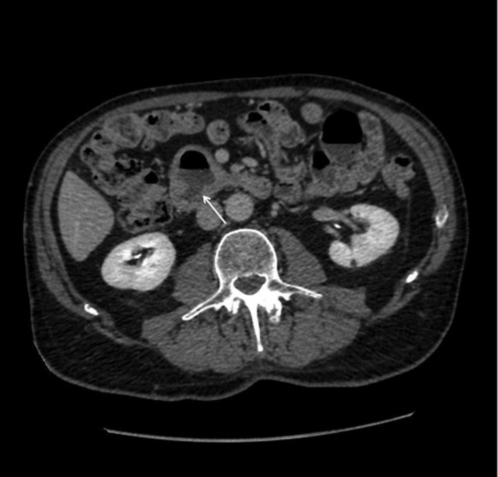 Fig. 12: Axial CT on the same patient as fig 11 shows