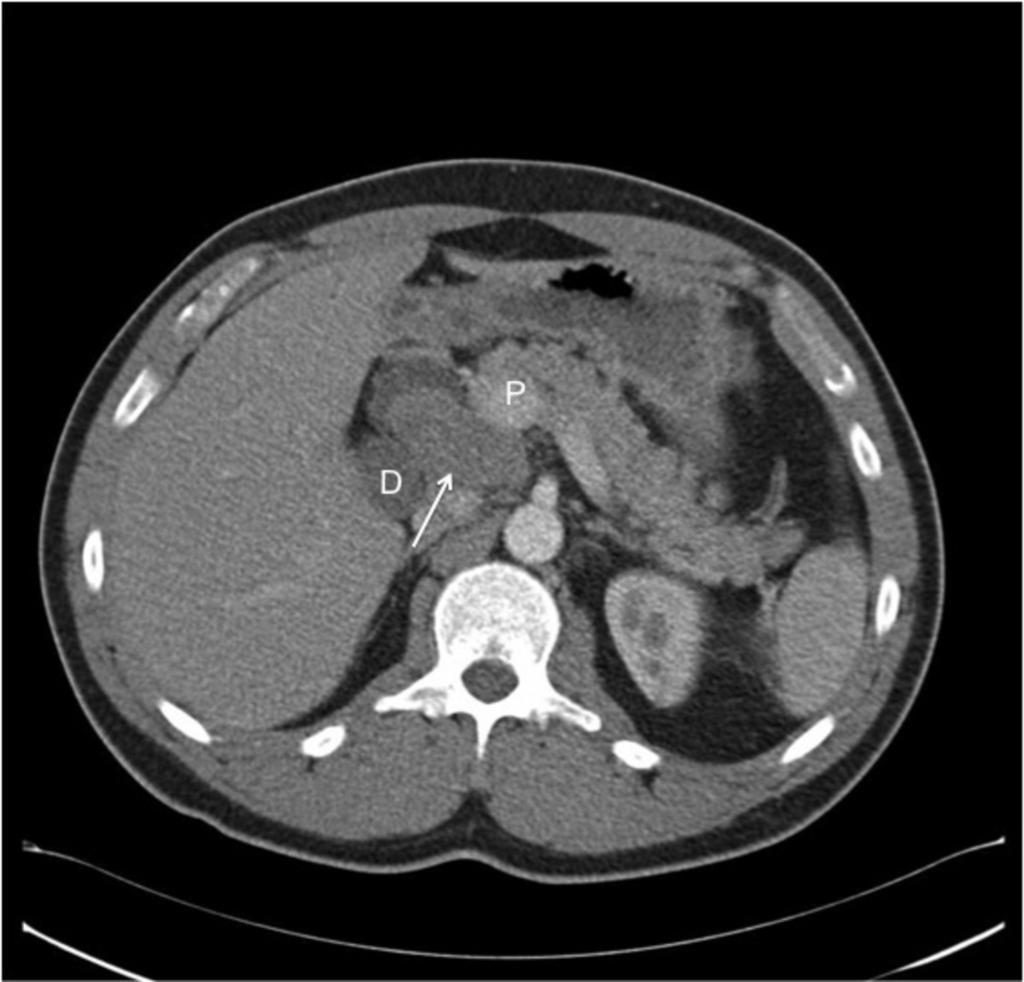 Fig. 13: Axial CT shows well circumscribed mass in the PD groove, displacing the duodenum and