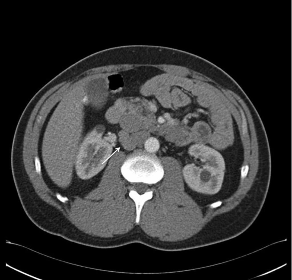 Fig. 14: Axial CT Fig 13 shows well circumscribed mass in the PD groove, displacing the duodenum and