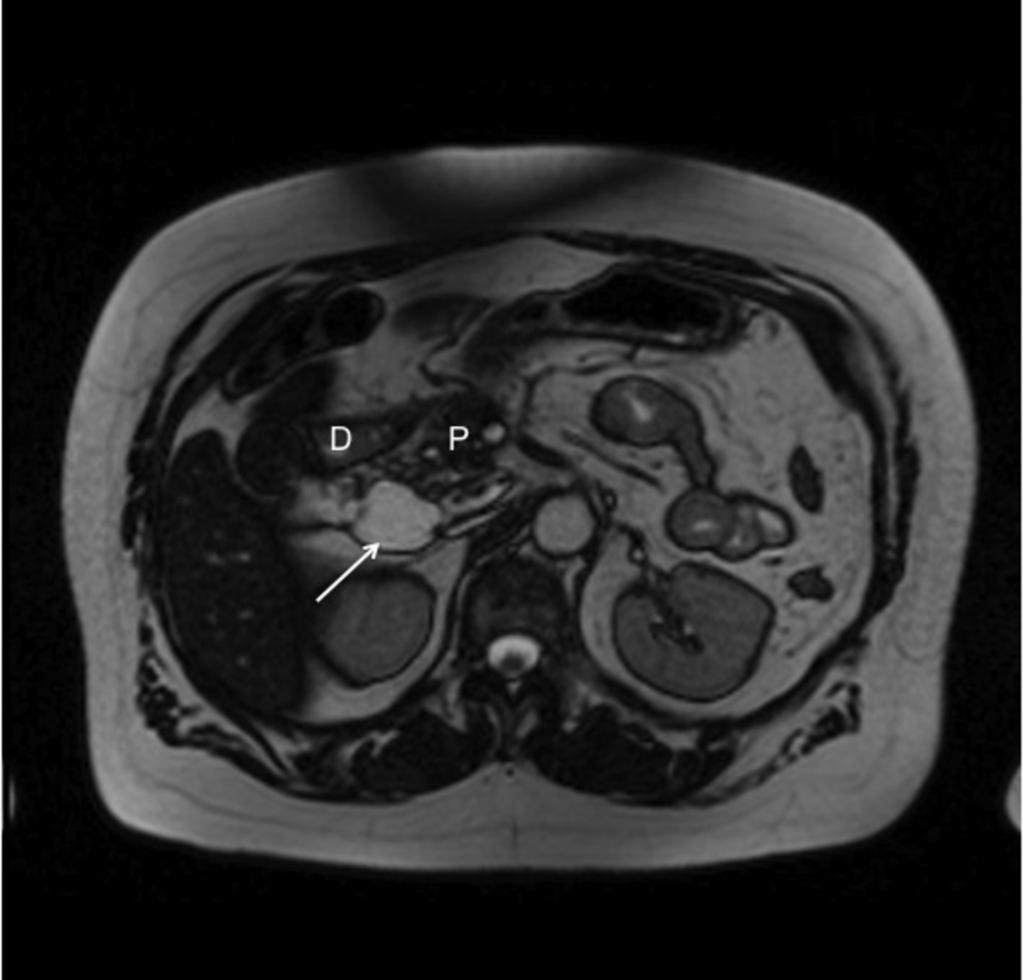 Fig. 18: T2 axial MRI showing a fluid signal encapsulated mass in the right retroperitoneum