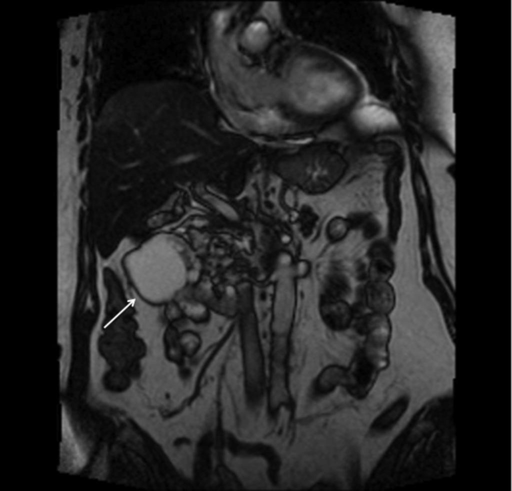 Fig. 20: Coronal T2 MRI showing fluid signal mass in the right retroperitoneum, which