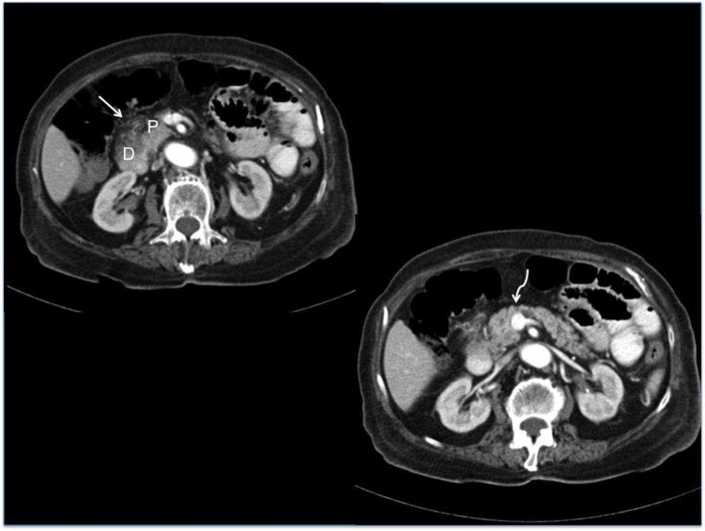 Fig. 3: Acute pancreatitis of the PD groove on axial contrast enhanced CT, showing fat stranding and