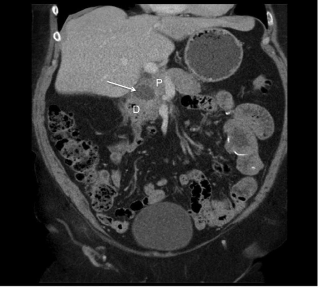 Fig. 4: Coronal CT.
