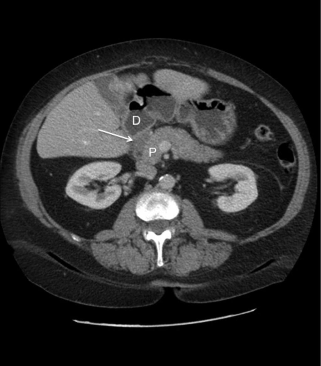 Fig. 5: Axial CT showing low attenuation ill-defined mass in