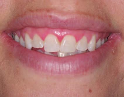 Bite alteration for reducing gummy smiles: Two case reports Author_ Dr David S. Frey, USA Fig. 1a Fig.