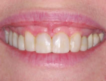 A frenectomy can also be performed, when appropriate, to remove a small portion of the lip frenulum with a diode laser.