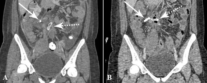 Figure 1. Abdomen and pelvic CT of a 15 year-old girl who had a perforated appendix. A. CT scan performed using standard setting (radiation dose, 10.9 mgy) B.