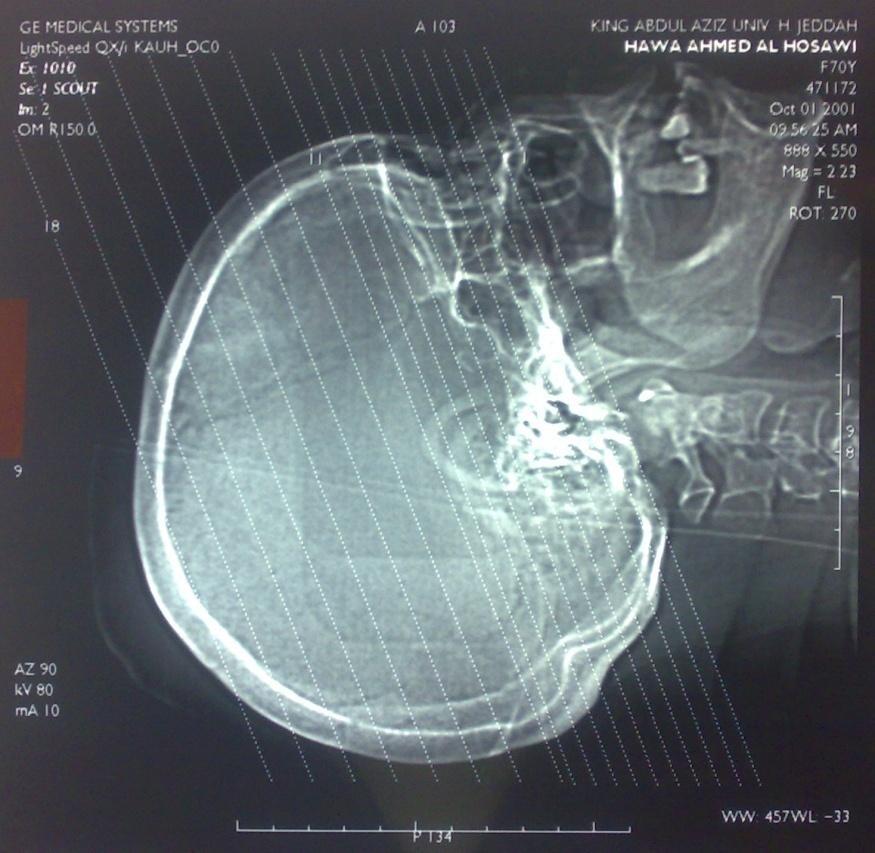 Image comments: 1) Scout view: 0,8-0,10 mm for leftover brain parts (Plan scan) is