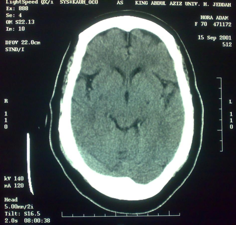 3) Brain Lobes (in the lower cuts): Frontal Lobe
