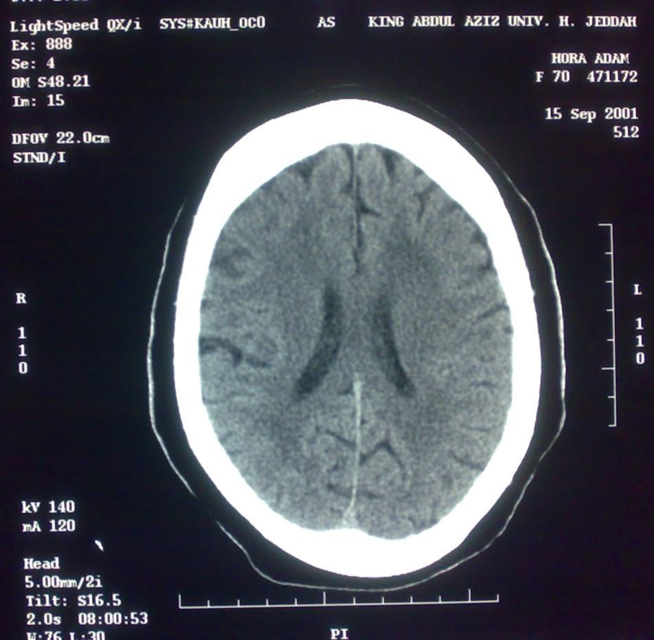 Occipital Lobe 4) Brain Lobes (in the middle cuts):