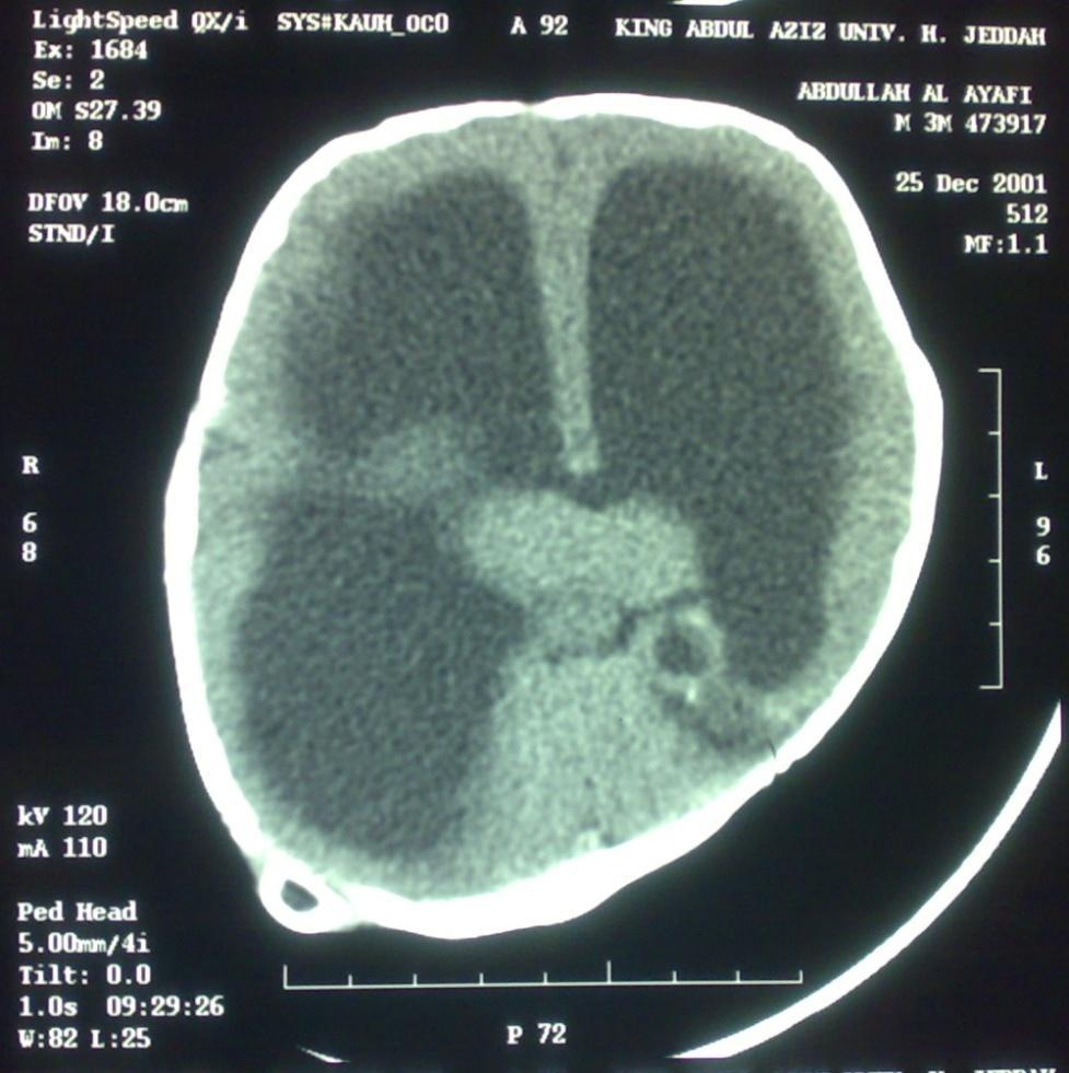 tube 12) Brain atrophy + Ventricles dilatation +