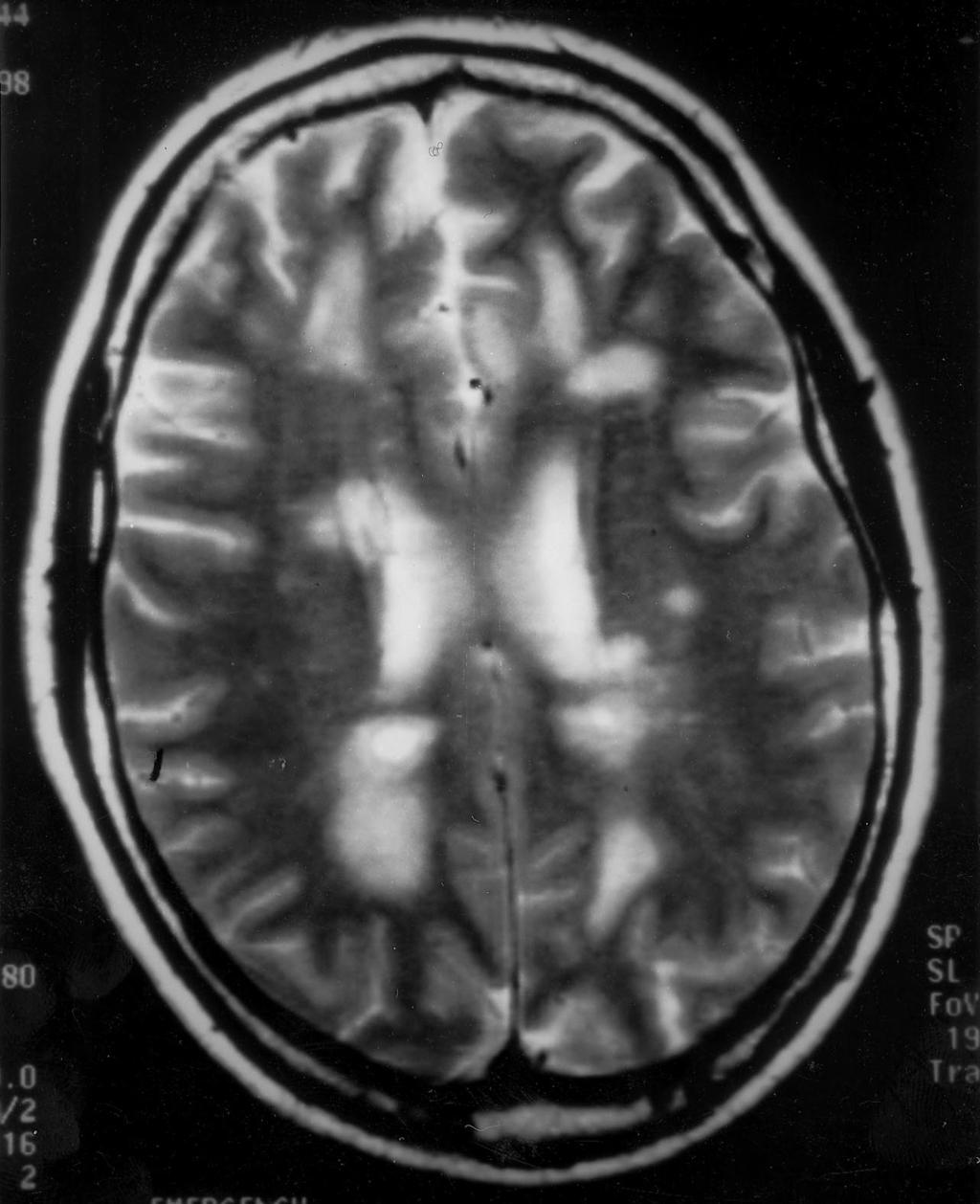Sectc.qxd 29/06/99 09:43 Page 98 The central nervous system A 25-year-old patient presented with a history of visual disturbances and pins and needles on two separate occasions.