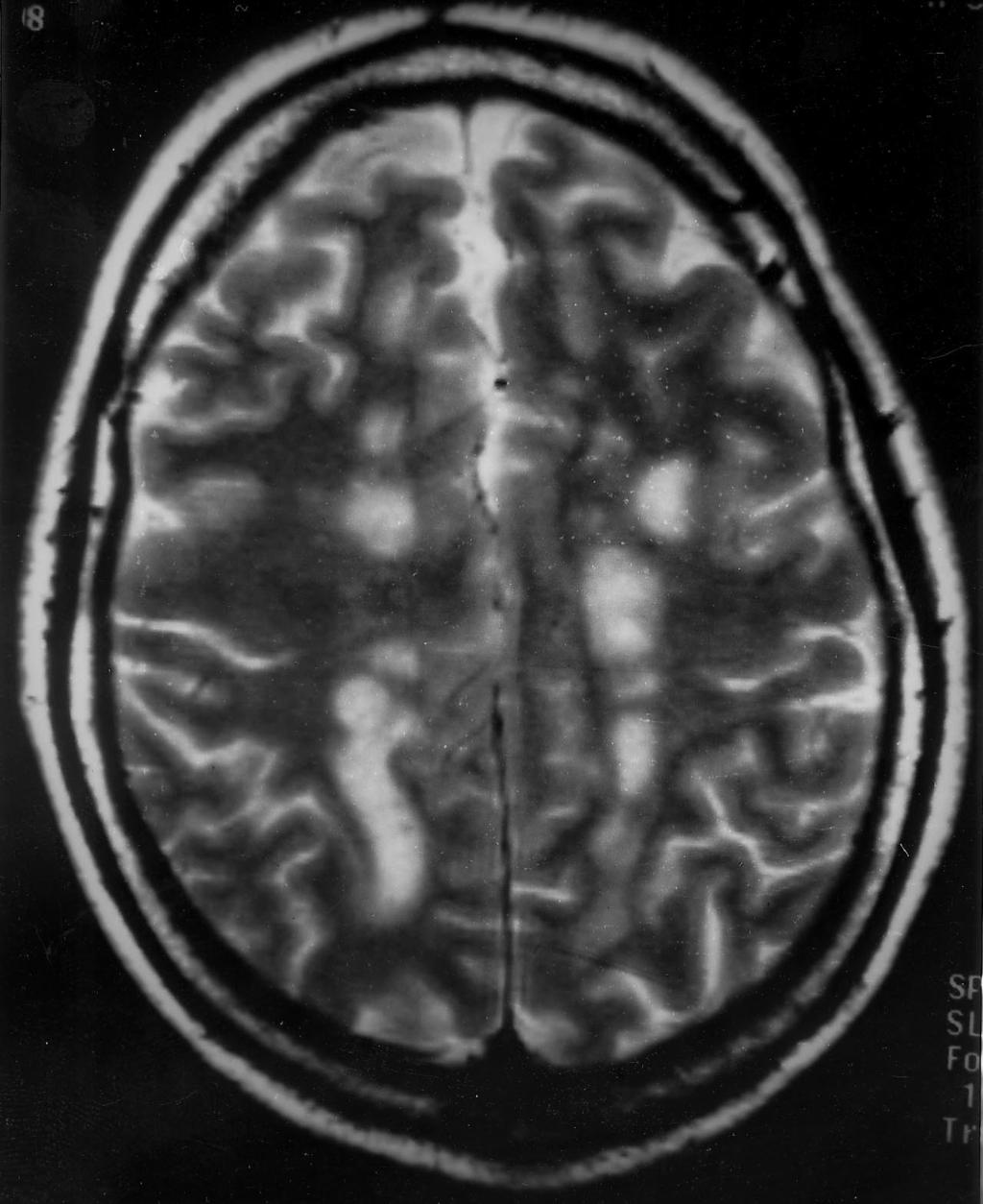 There are areas of increased signal (white) in the white matter of the brain.