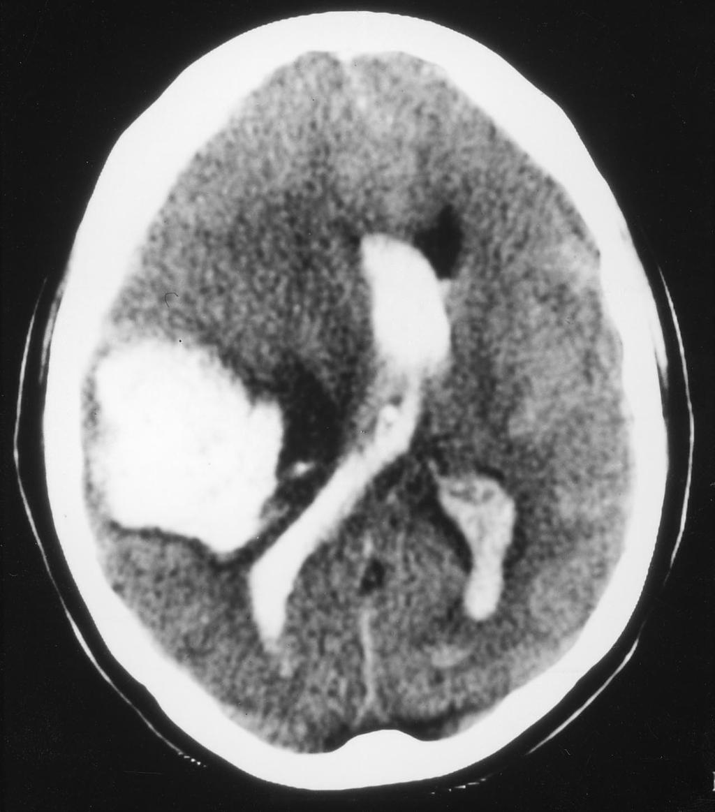 The right lateral ventricle is not clearly seen. 84 Fig. C3 Section of a CT scan showing a very large right-sided intra-cerebral haematoma. The blood is fresh because the attenuation is white.